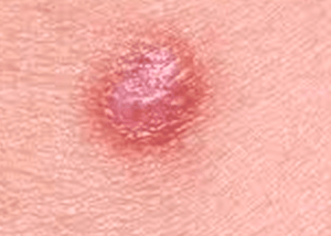 Dermatofibroma