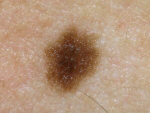 brown spot