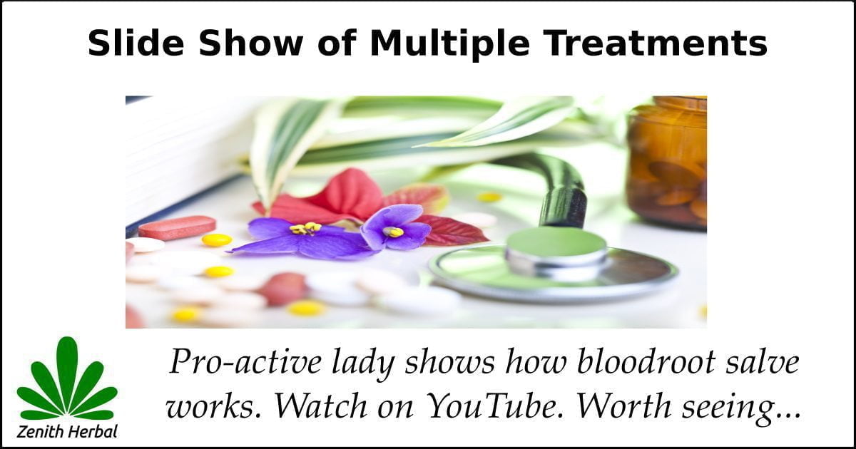 Youtube Video of Bloodroot Salve Treatments Zenith Herbal We're all