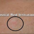 Initial Red irritation
