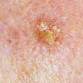 5dermnet photo of actinic keratosis on face 120x120 1