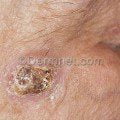 5squamous cell carcinoma face 9 120x120 1