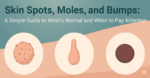 Skin Spots, Moles, And Bumps