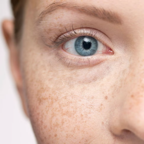 Skin Spots, Moles, and Bumps: A Simple Guide to What’s Normal and When to Pay Attention 2 Freckles as Skin Spot