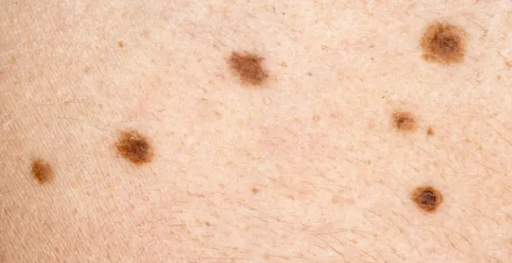 Skin Spots, Moles, and Bumps: A Simple Guide to What’s Normal and When to Pay Attention 3 Skin Spot: Mole