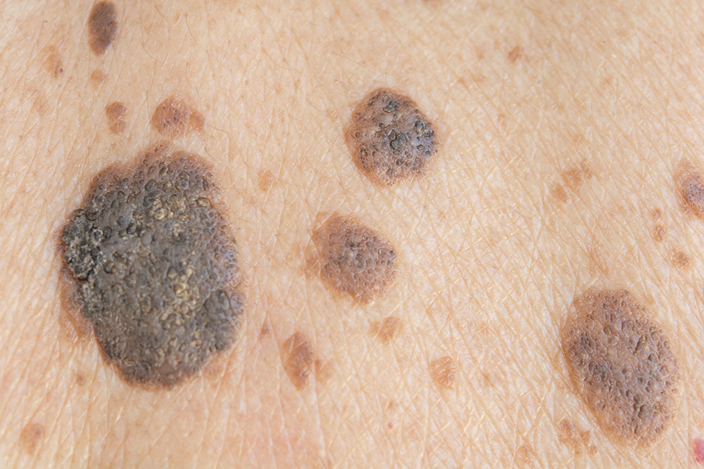 Skin Spots, Moles, and Bumps: A Simple Guide to What’s Normal and When to Pay Attention 5 Skin Spot: Seborrheic Keratosis