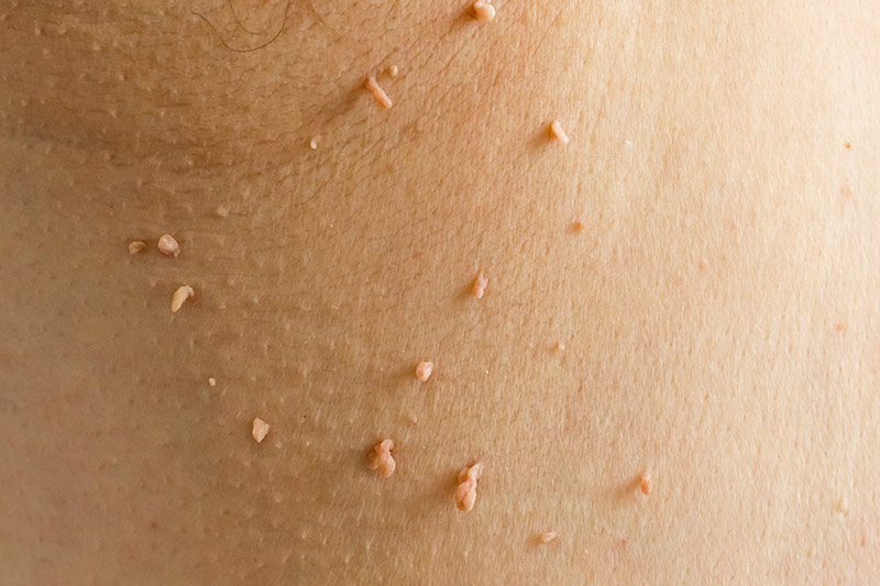 Skin Spots, Moles, and Bumps: A Simple Guide to What’s Normal and When to Pay Attention 4 Skin Spot: Skin Tags