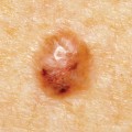 basal-cell-carcinoma